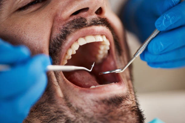 Best Emergency Gum Treatment in Mentone, CA